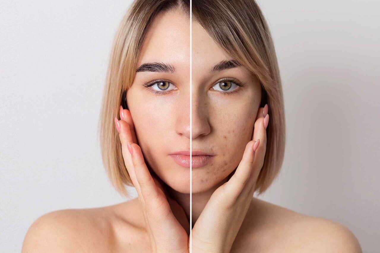 Botox – Before & After
