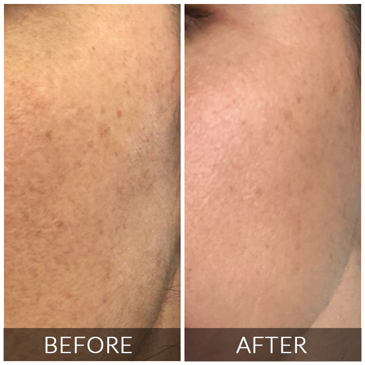 BEFORE-AFTER 3 https://silkaestheticsstudio.co.za/wp-content/uploads/2026/08/BEFORE-AFTER-3.jpg